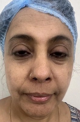 After Enhanced Volume