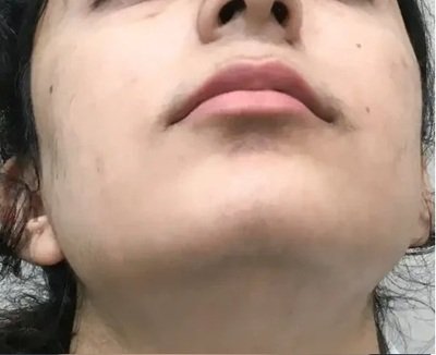 After Laser Hair Removal