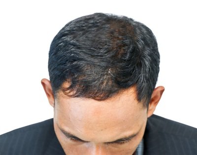 After Hair Regrowth